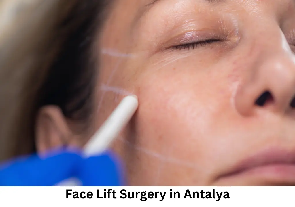 Face Lift Surgery In Antalya 1