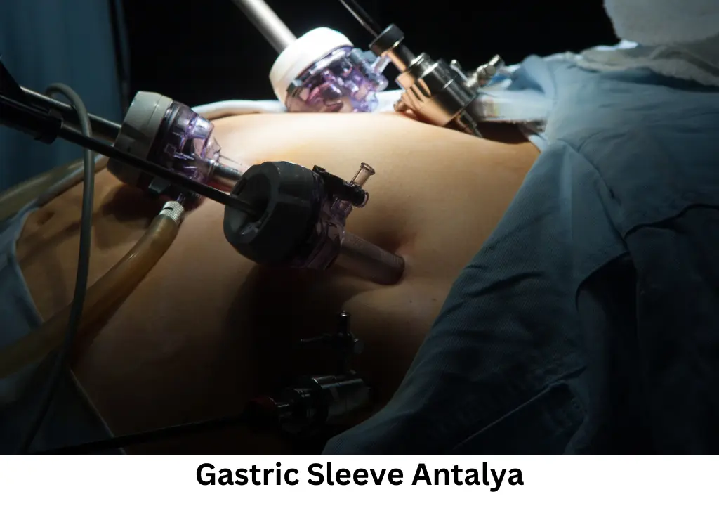 Gastric Sleeve Antalya 2