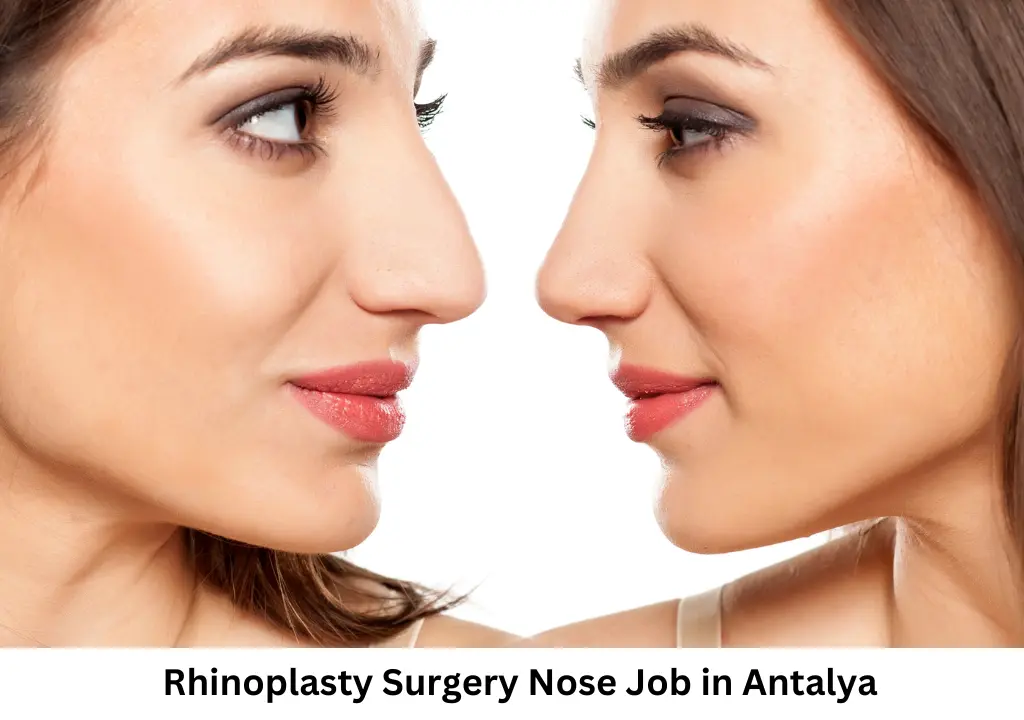 Rhinoplasty Surgery Nose Job In Antalya