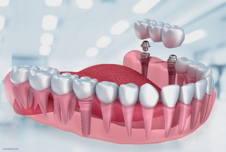 Dental Implant Treatment In Antalya: 5 Best Price Clinic