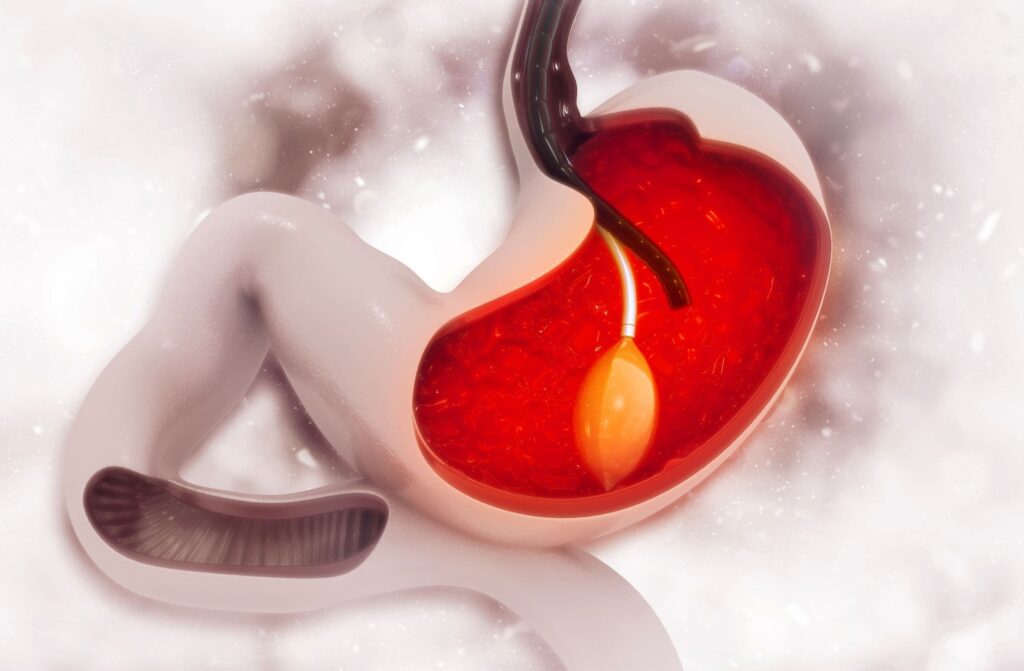 Antalya Swallowable Gastric Balloon;